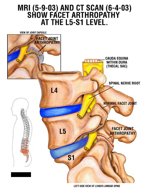 L5 s1 facet joint